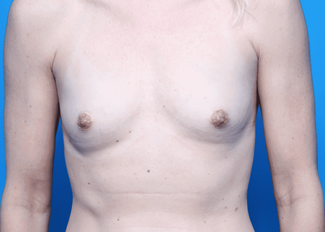 Breast case #162 before