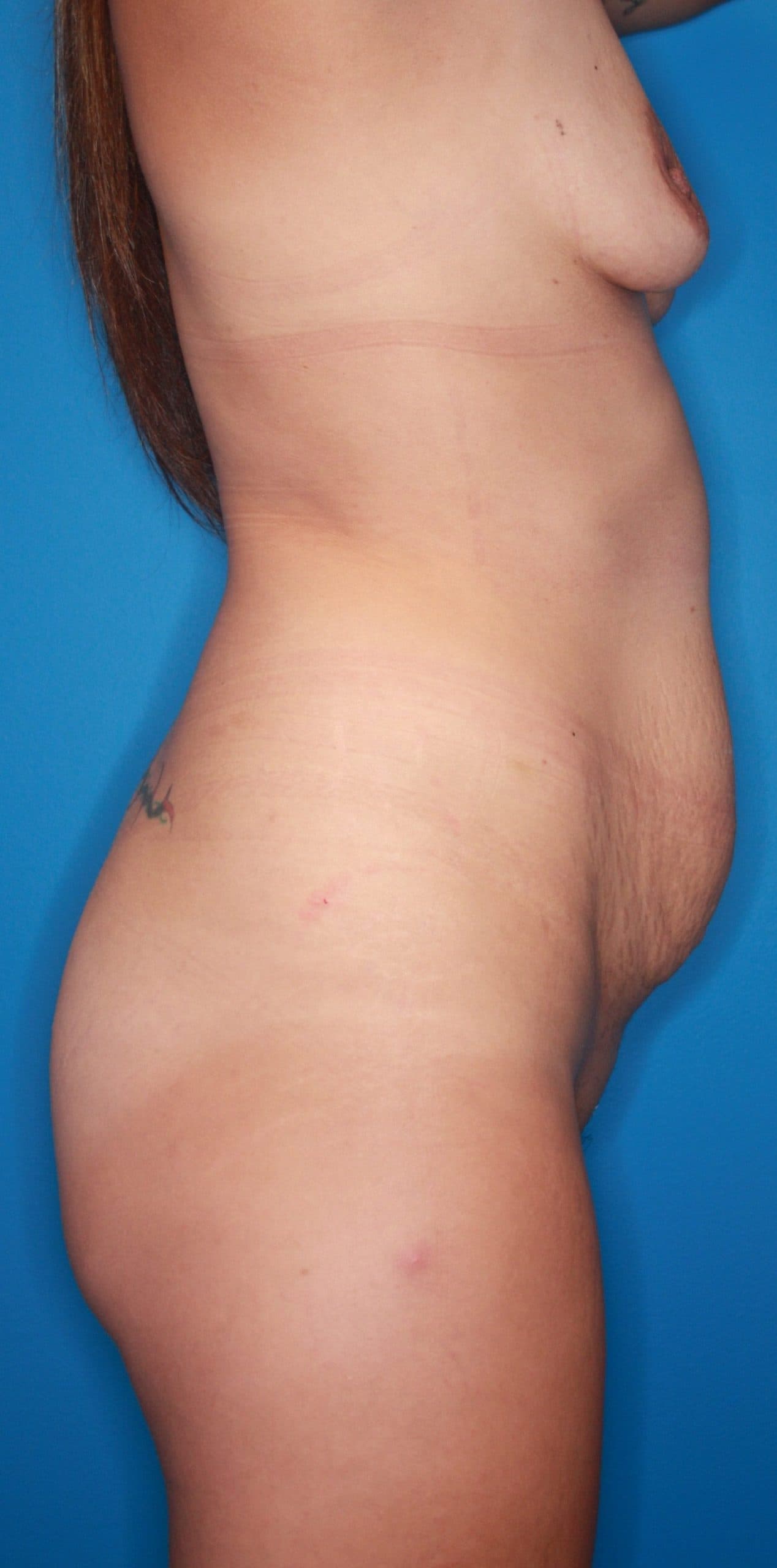 Body case #150 before, image 4
