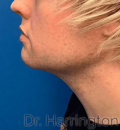 Face case #8026 after