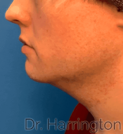 Face case #8026 before