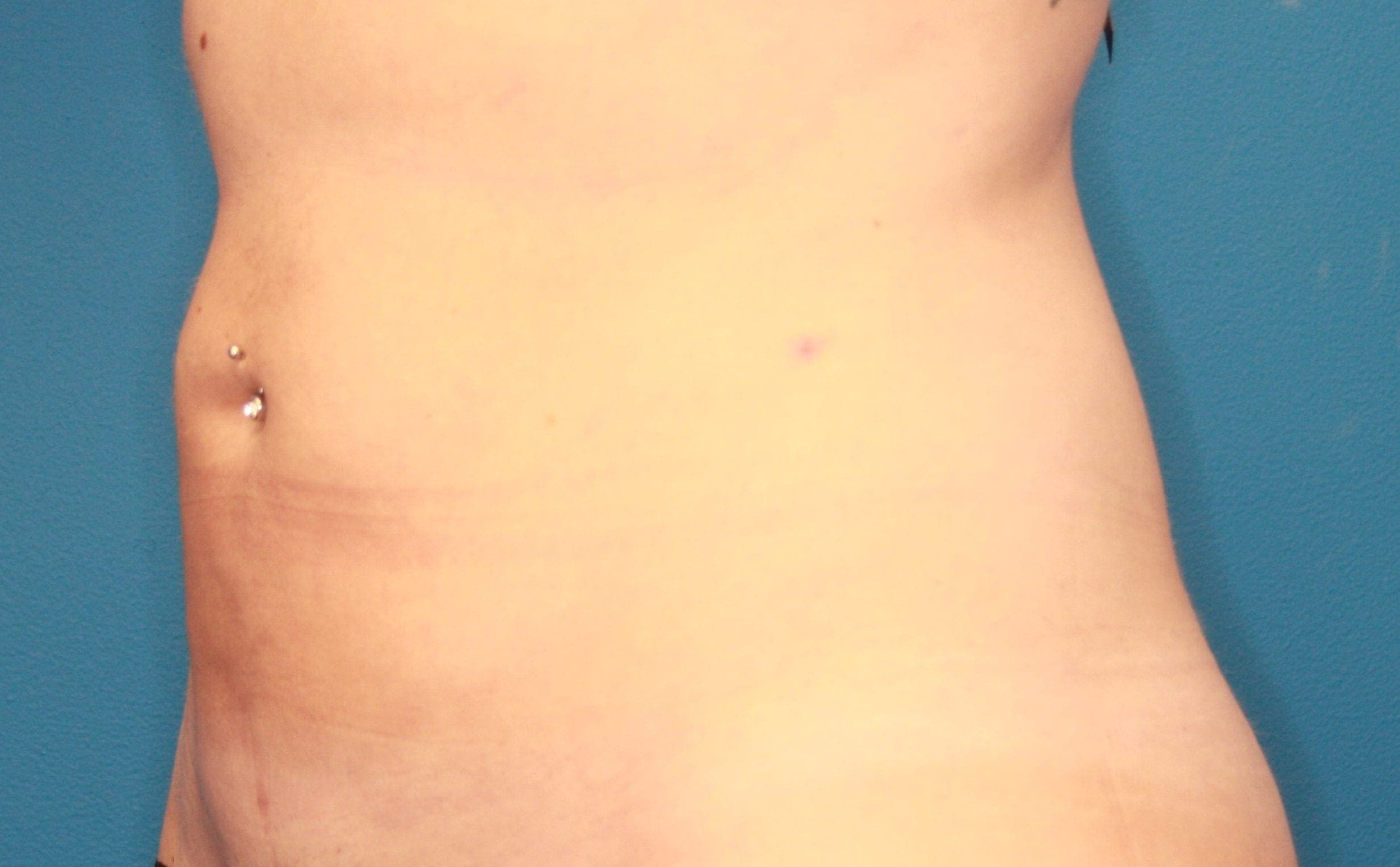 Body case #155 after, image 2