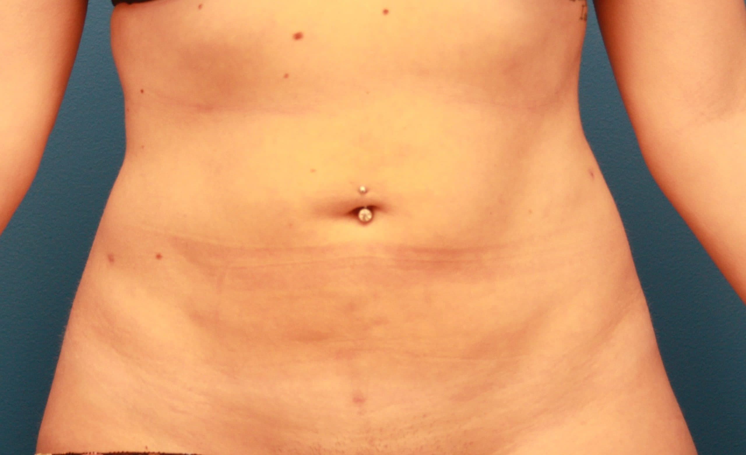 Body case #155 after