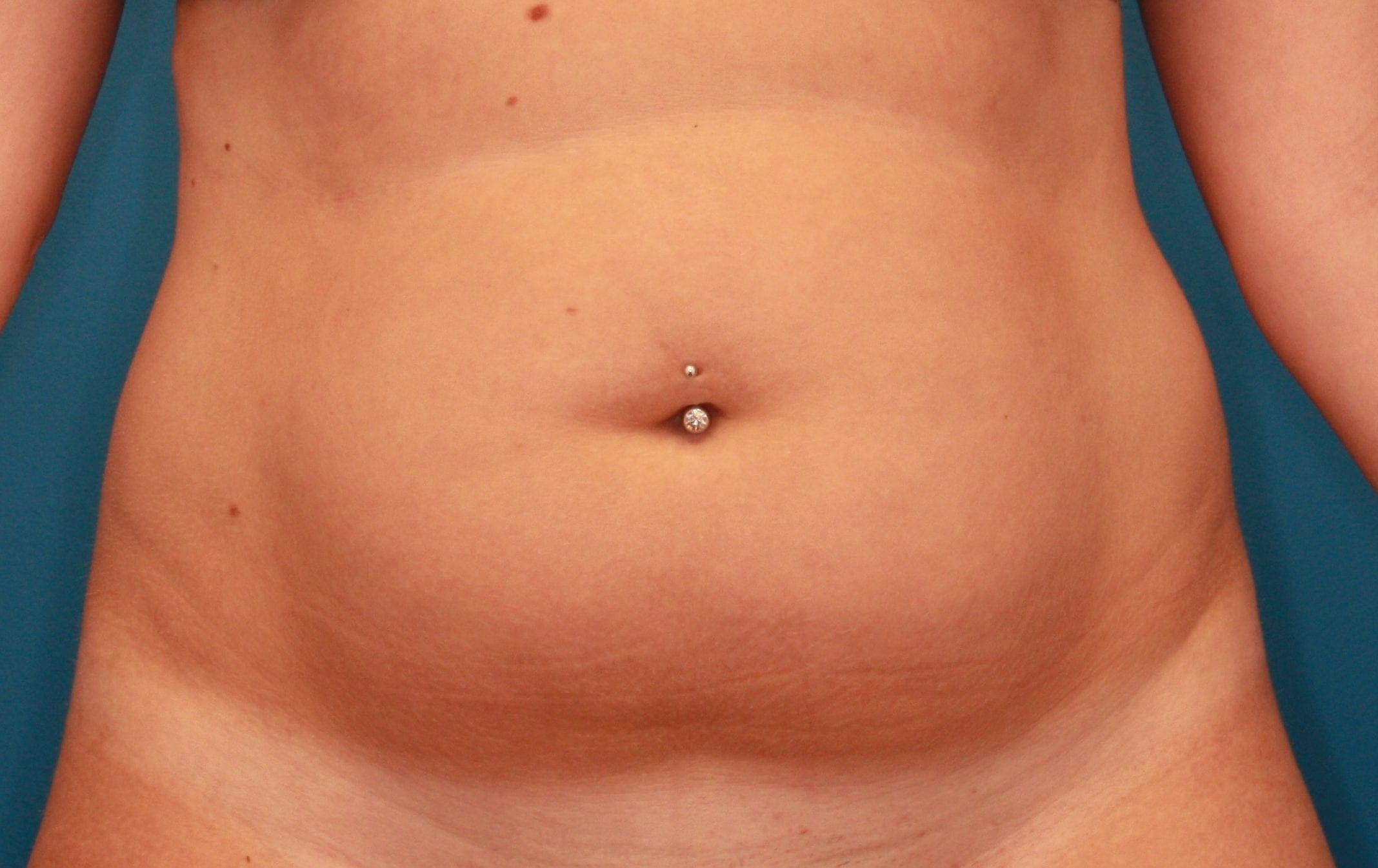 Body case #155 before