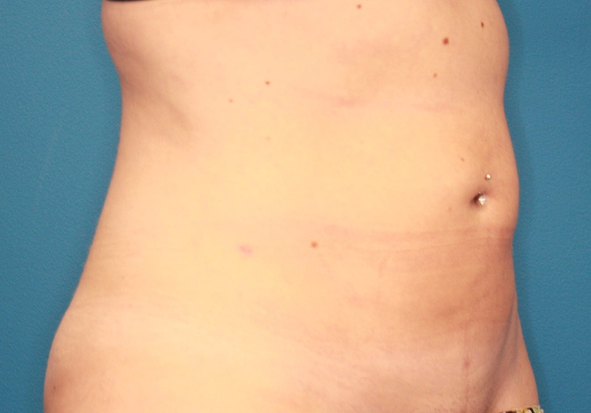 Body case #155 after, image 4
