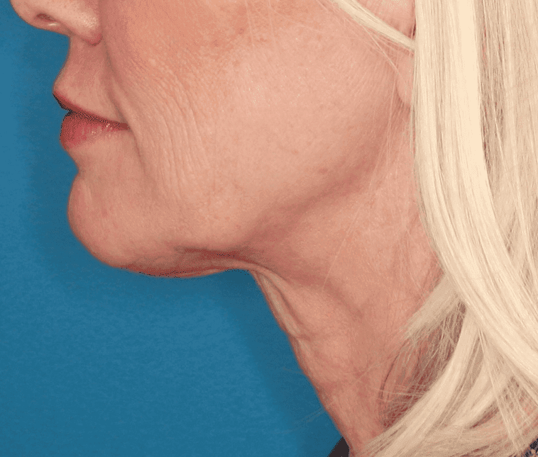 Face case #157 after