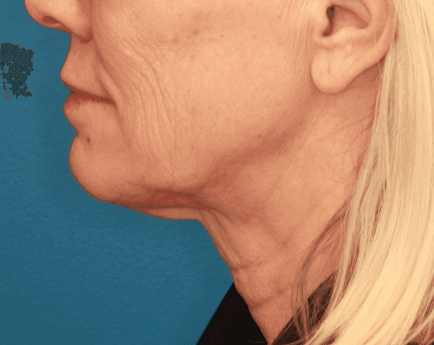 Face case #157 before