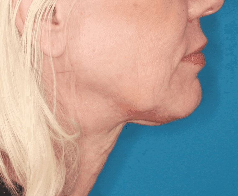 Face case #157 after, image 2