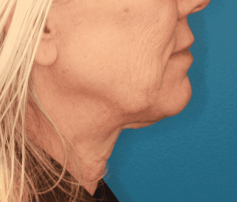 Face case #157 before, image 2
