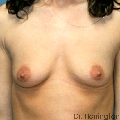 Breast case #67 before