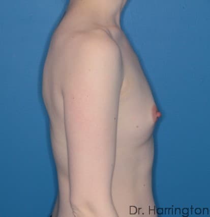 Breast case #99 before, image 2
