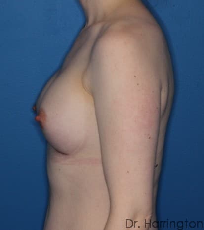 Breast case #99 after, image 3