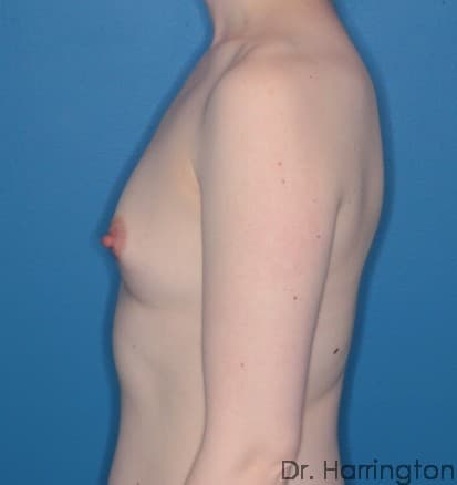 Breast case #99 before, image 3