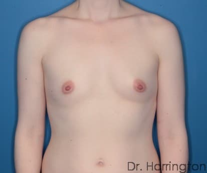 Breast case #99 before