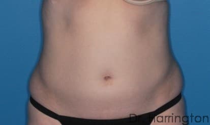 Body case #89 before