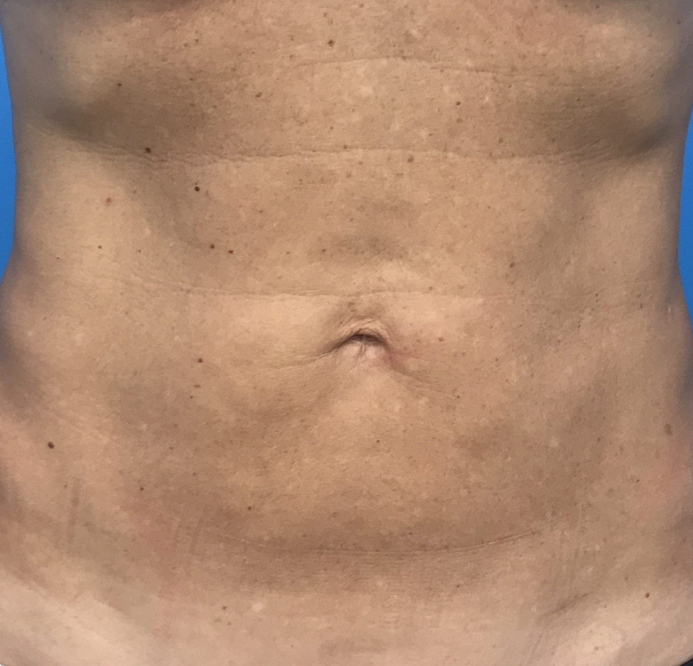 Body case #201 after