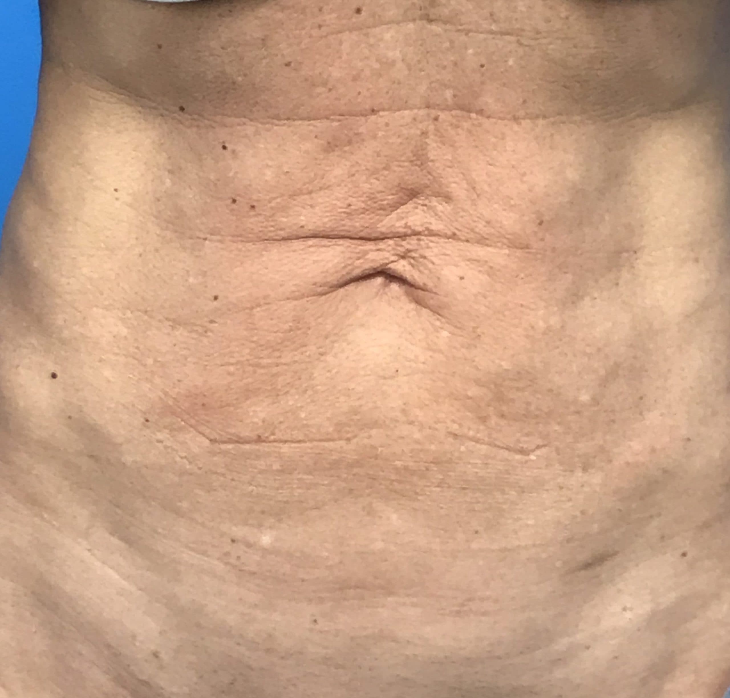 Body case #201 before