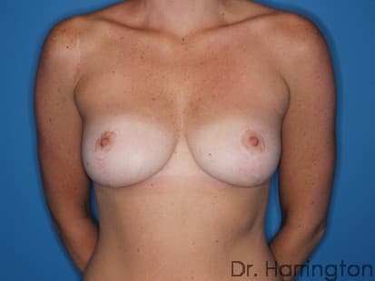 Breast case #109 after