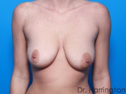 Breast case #109 before
