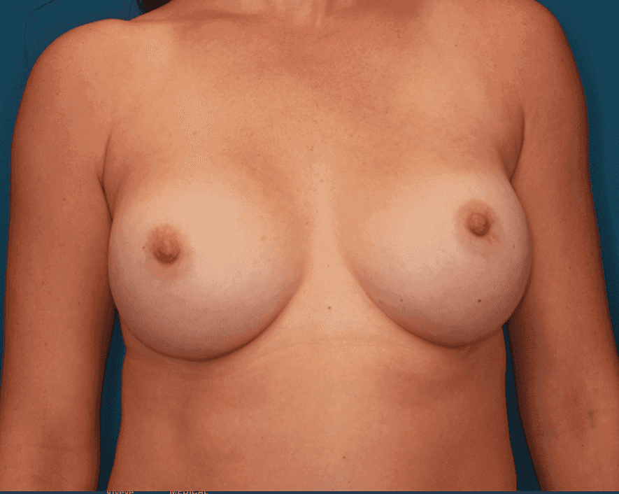Breast case #159 after