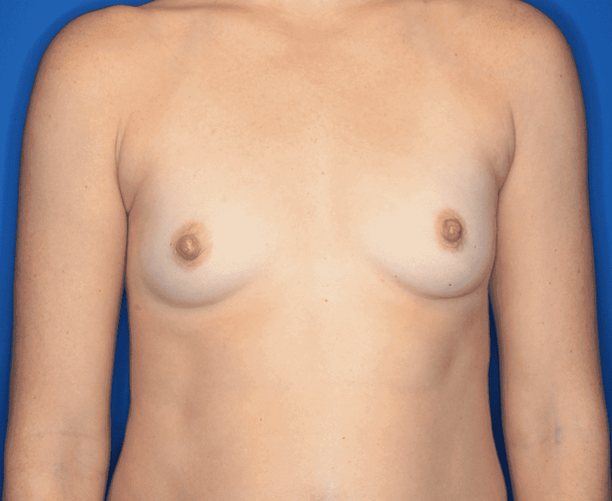Breast case #159 before