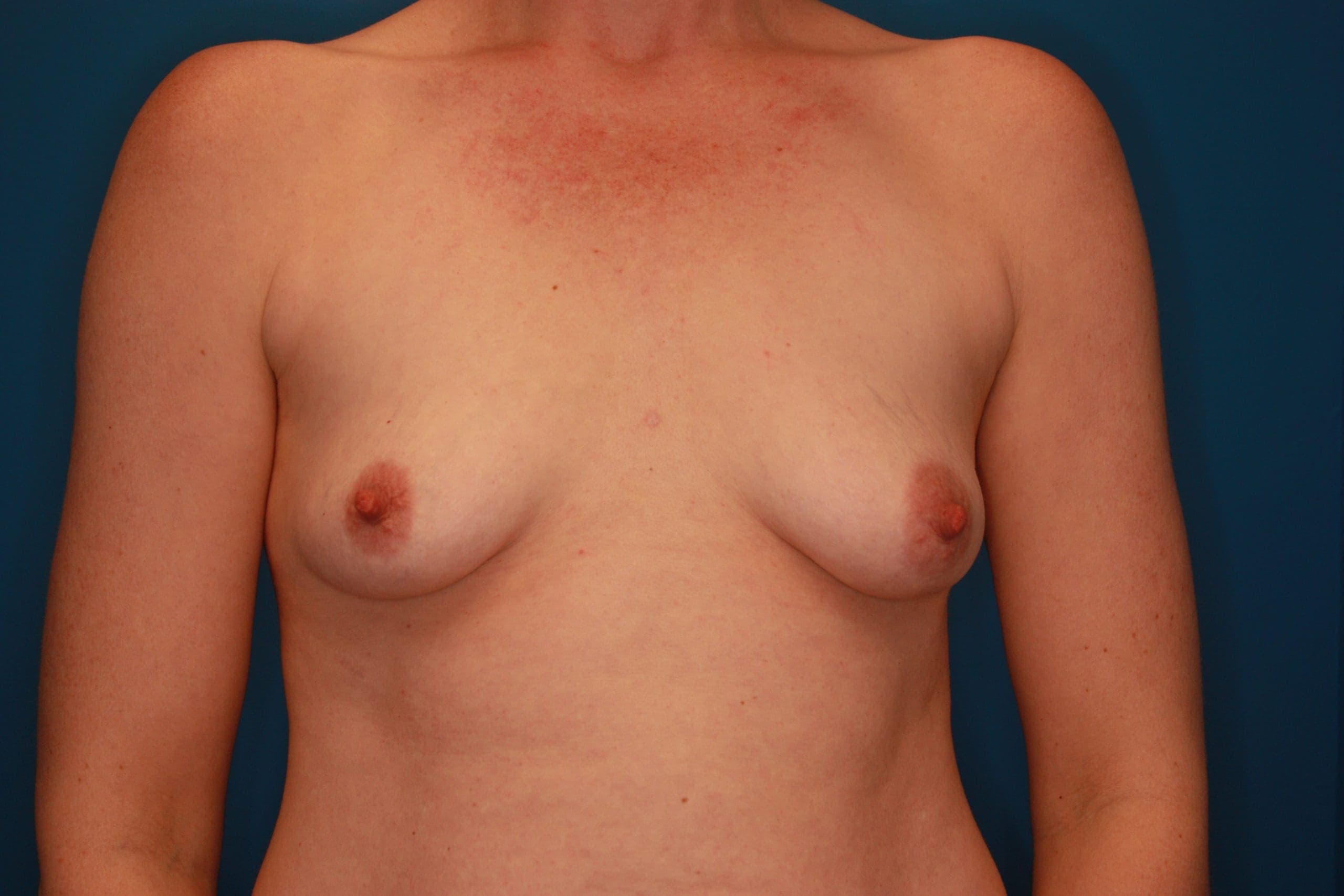 Breast case #174 before