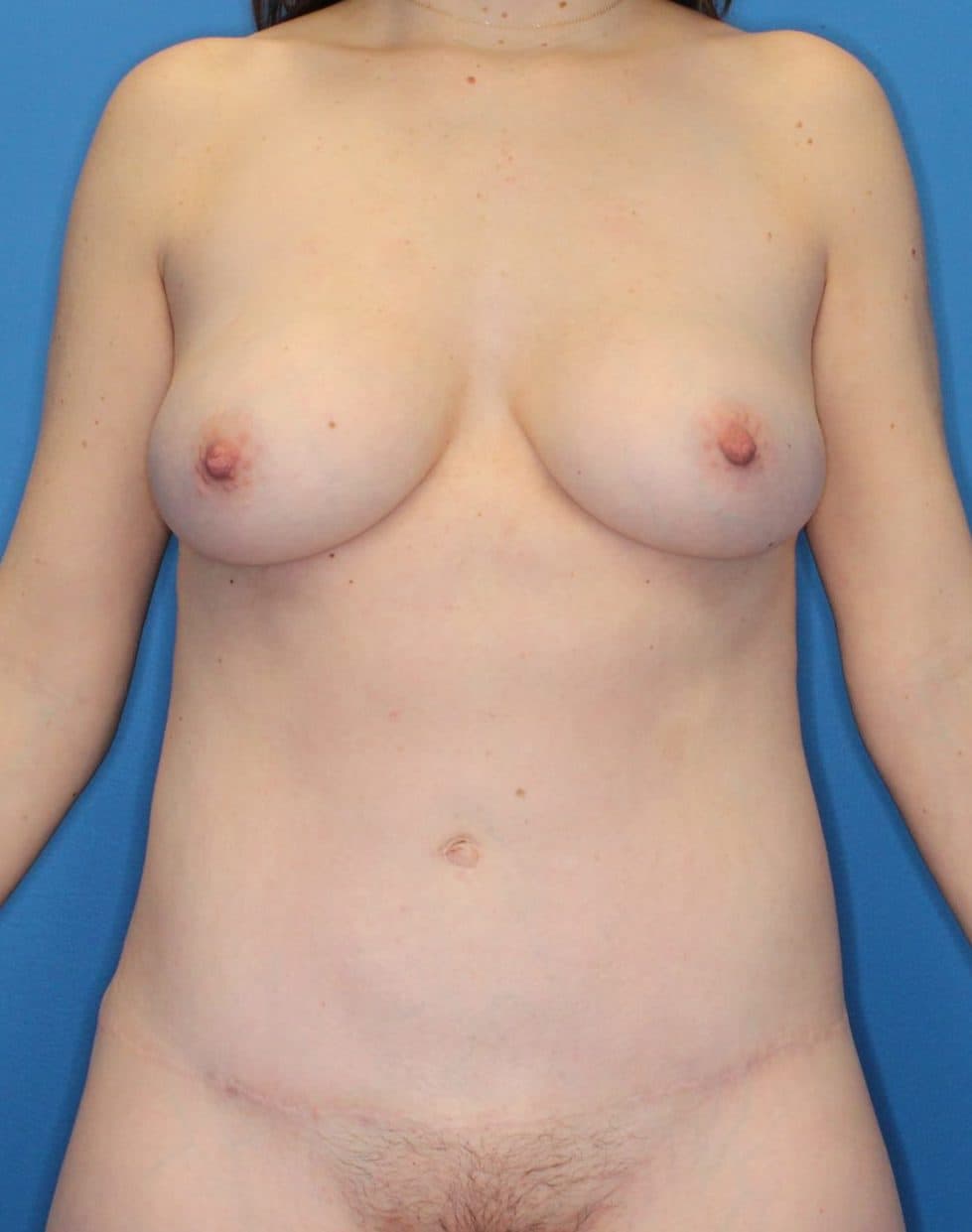 Body case #179 after