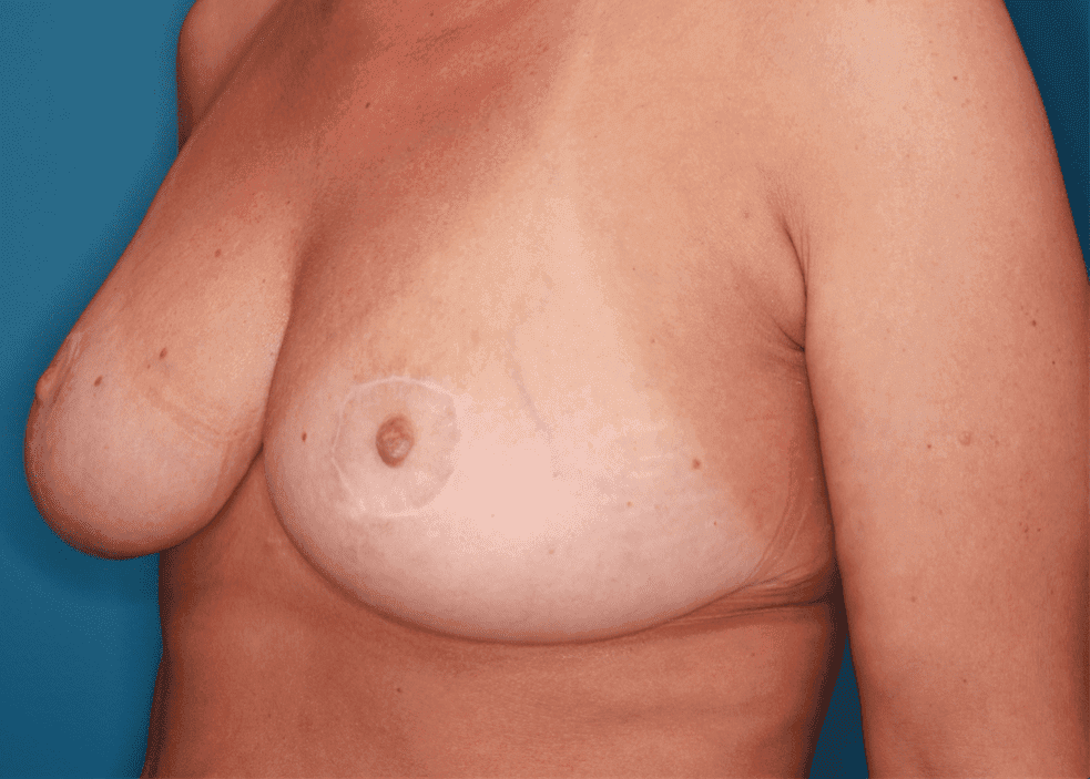 Breast case #161 after