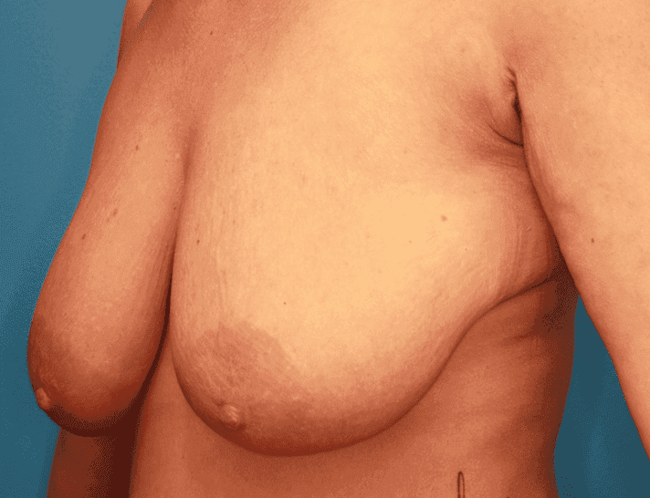 Breast case #161 before