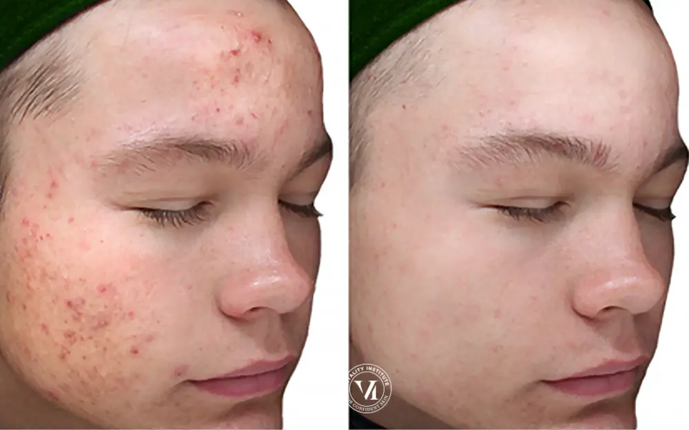 Before and after result 10