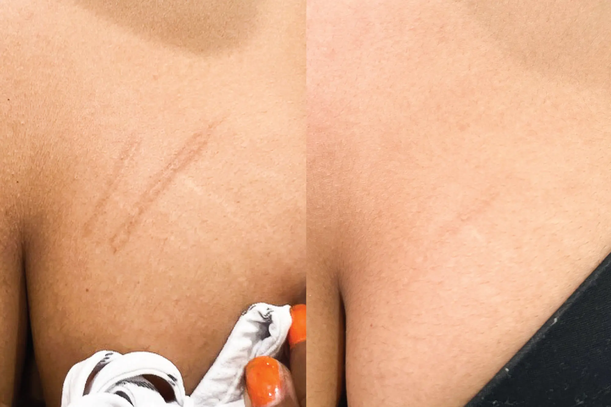 Before and after result 14