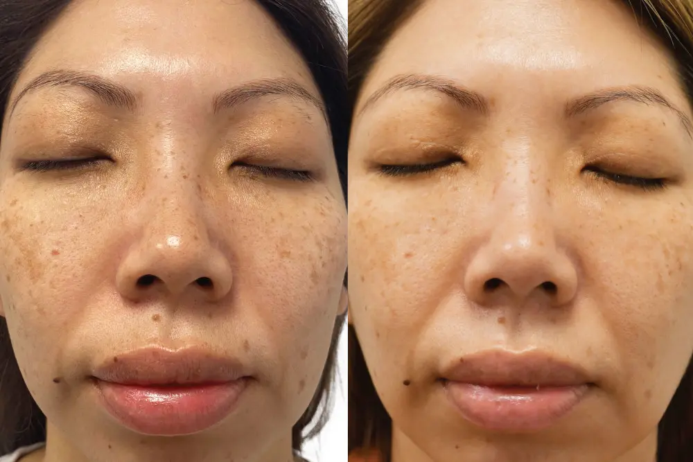 Before and after result 2