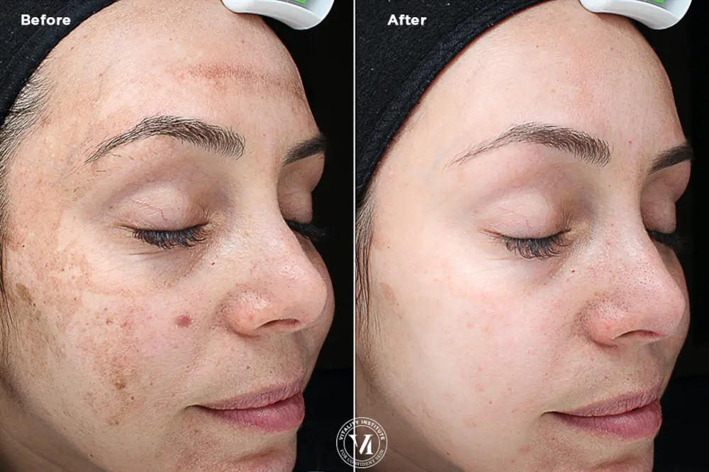 Before and after result 1