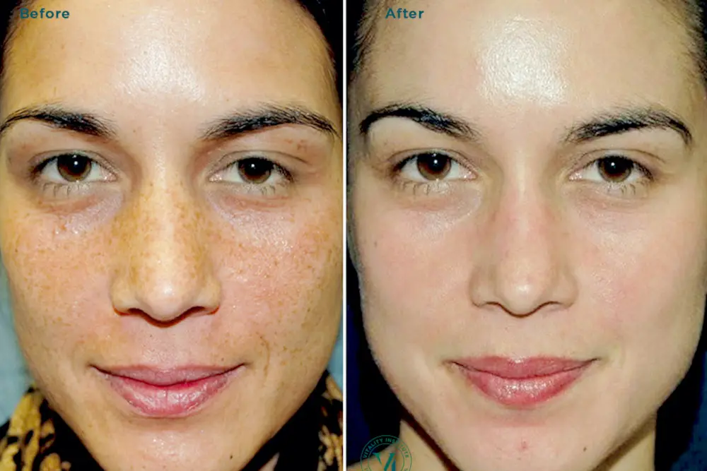 Before and after result 6