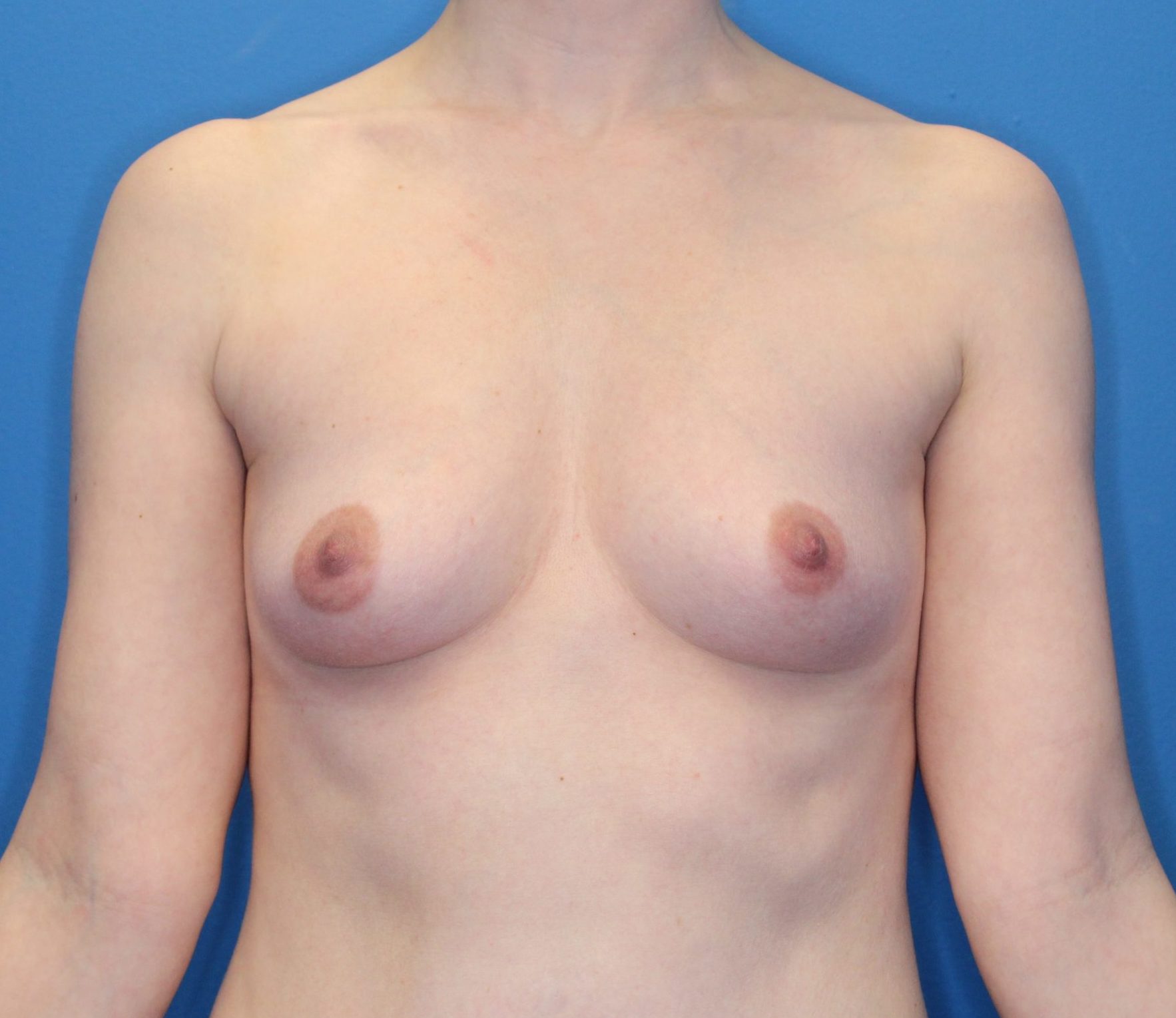 Case 177 - Before
