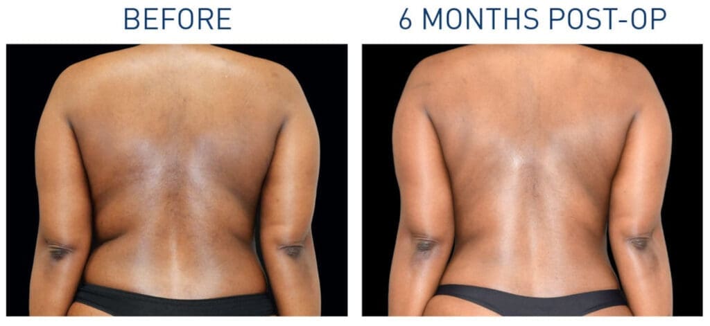 Renuvion Before and After 6