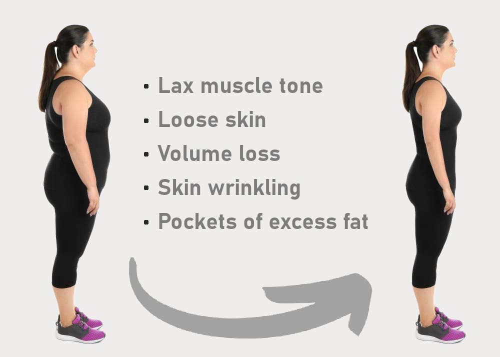post weight loss treatments