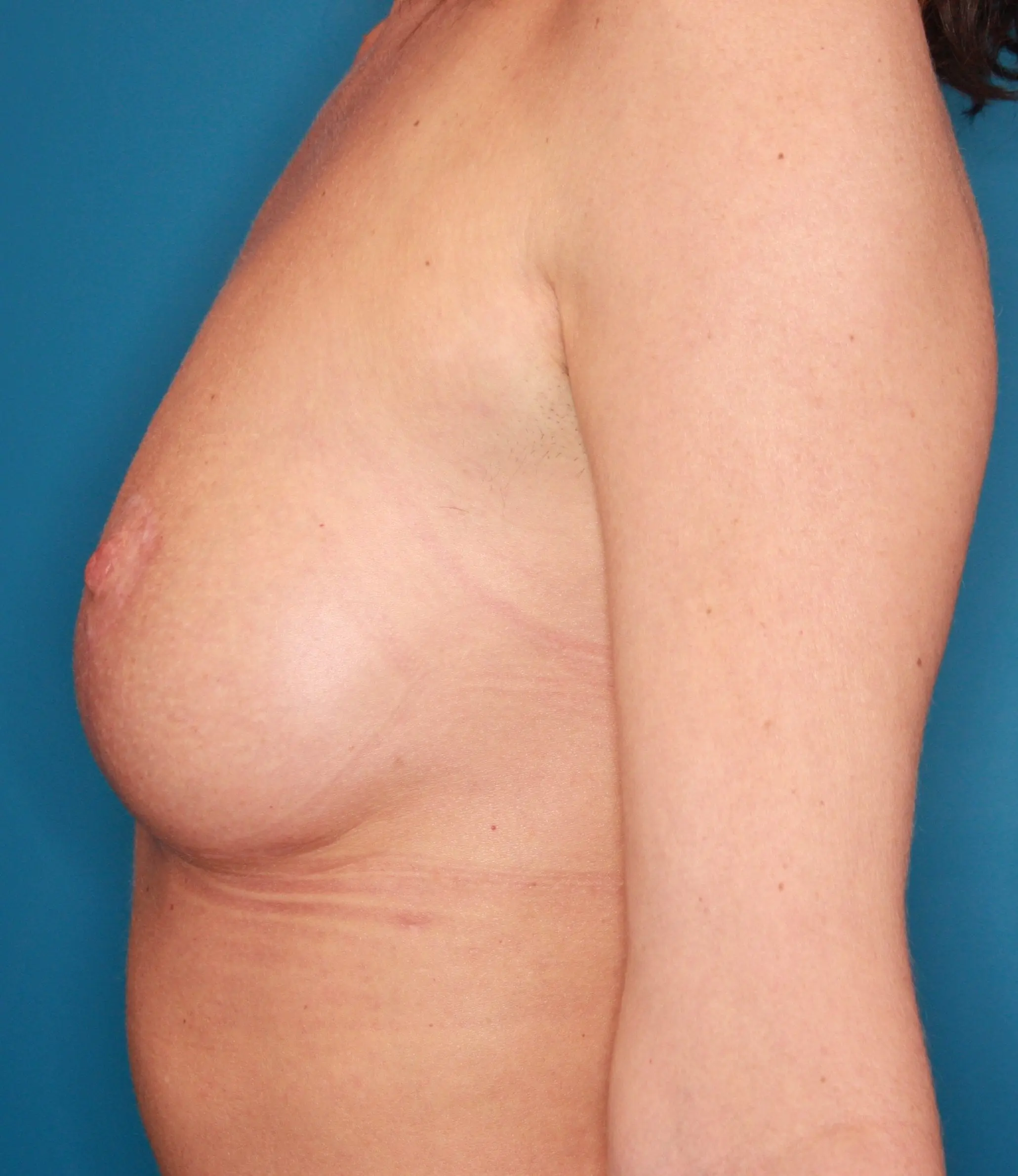 Breast Lift Patient Photo - Case 156 - after view-2