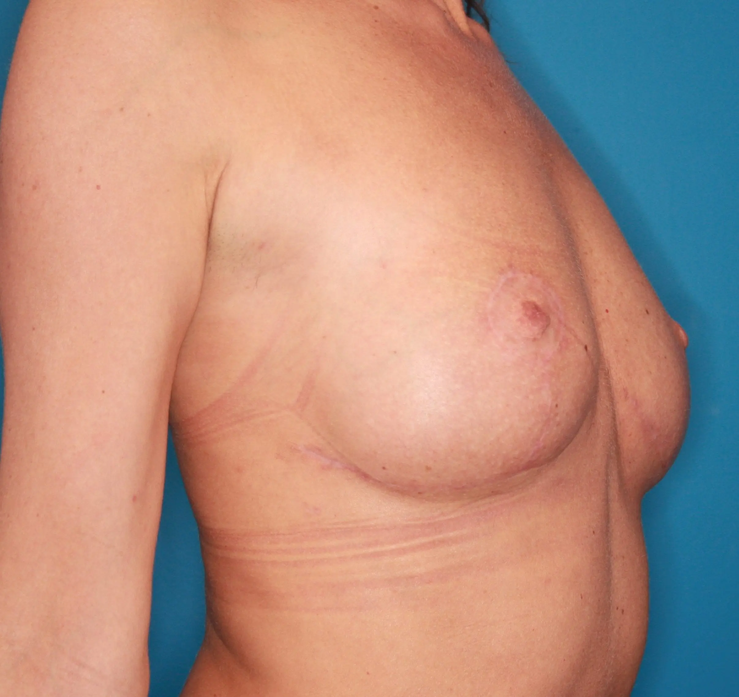 Breast Lift Patient Photo - Case 156 - after view-3