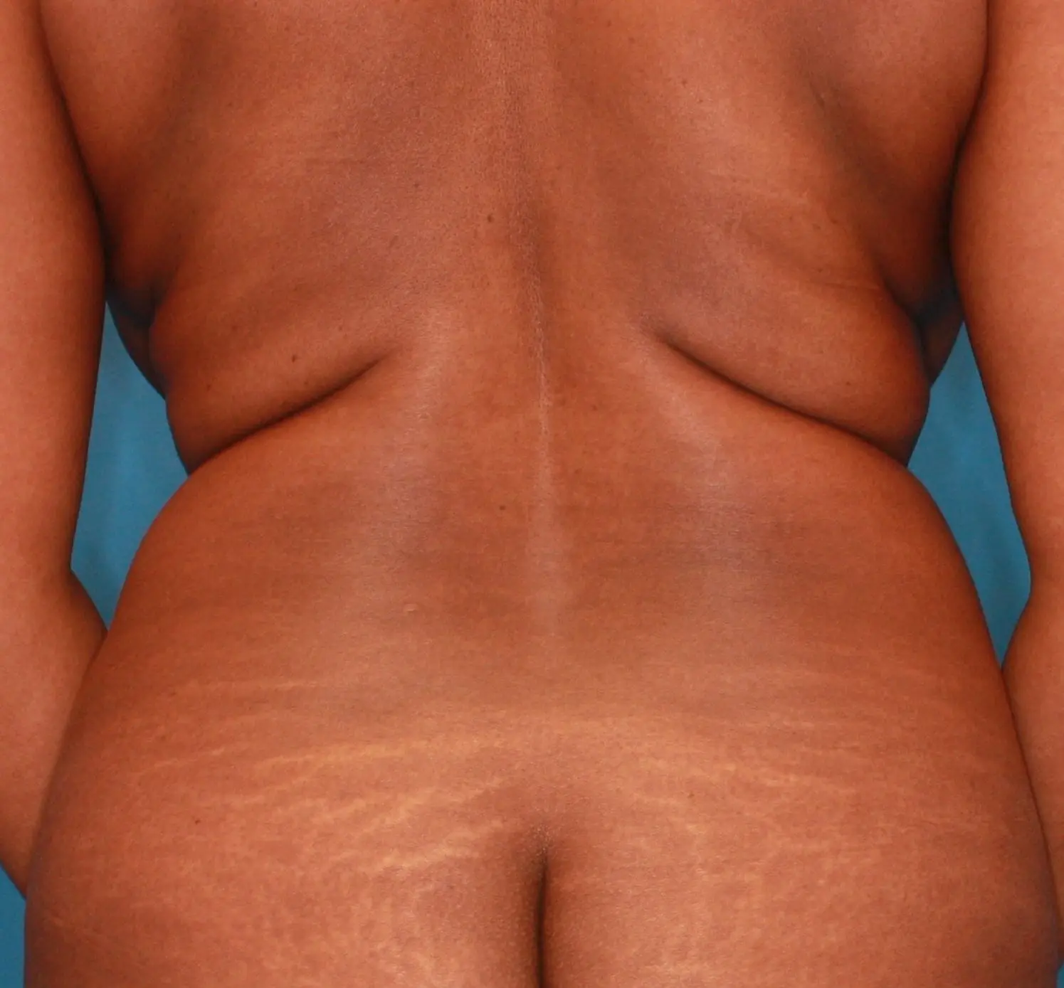 Breast Lift Patient Photo - Case 165 - before view-3