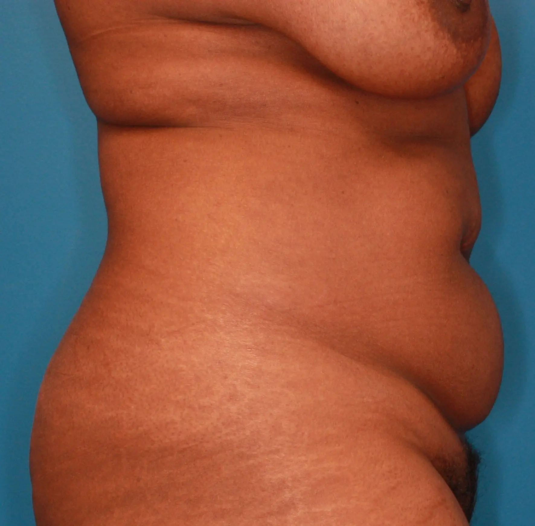 Breast Lift Patient Photo - Case 165 - before view-5
