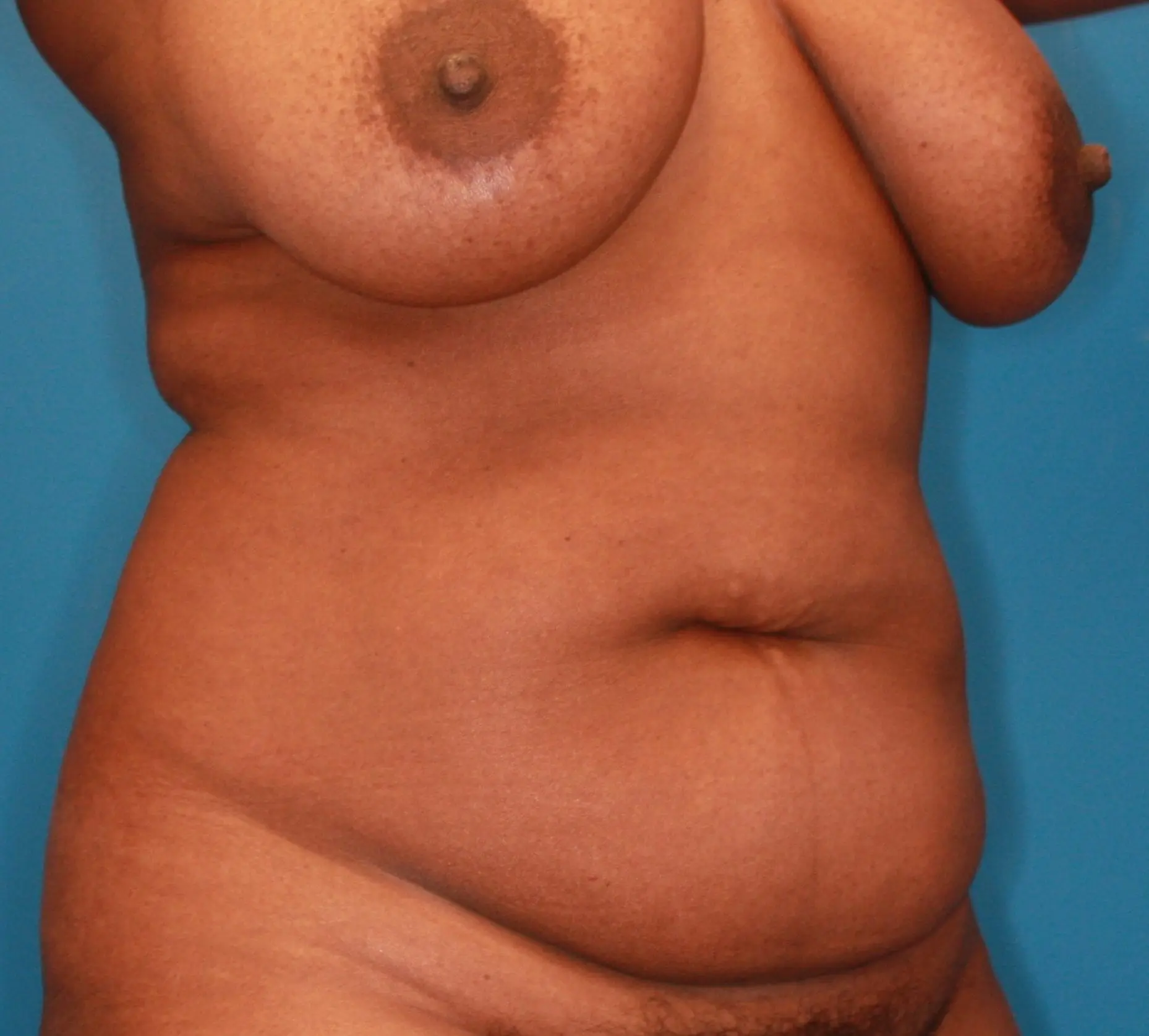 Breast Lift Patient Photo - Case 165 - before view-4