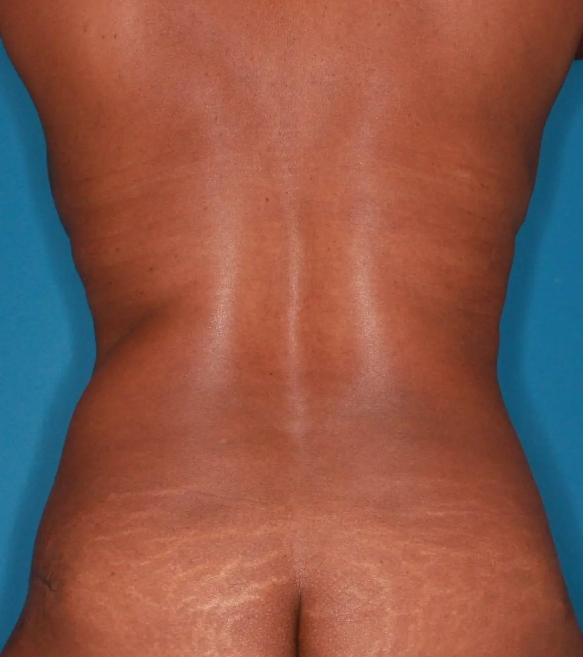 Breast Lift Patient Photo - Case 165 - after view-3