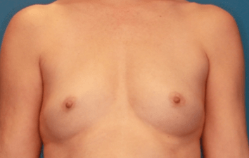 Breast Augmentation Patient Photo - Case 5049 - before view-1