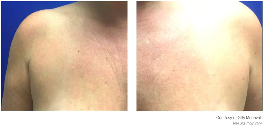 Genius patient before and after photo 1