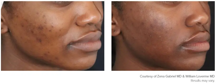 Genius patient before and after photo 2