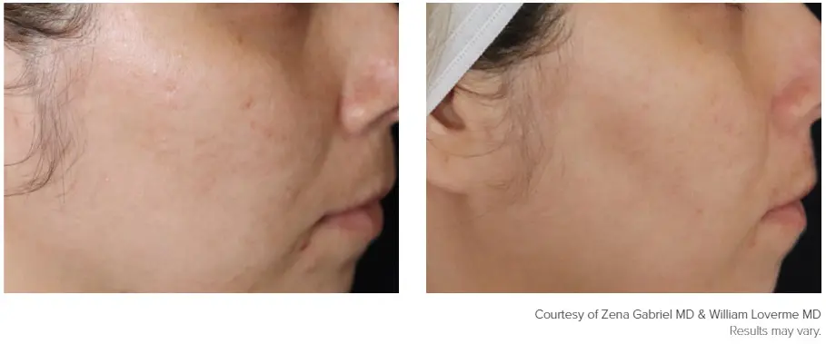 Genius patient before and after photo 3