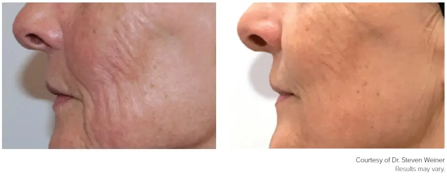 Genius patient before and after photo 4