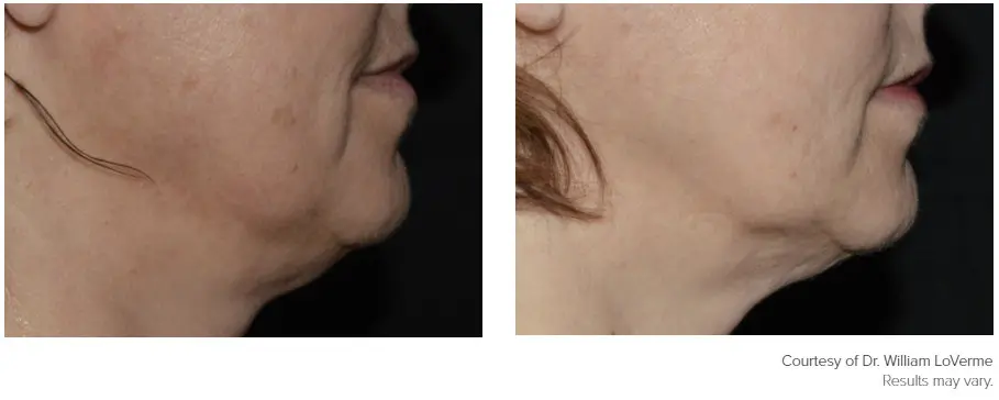 Genius patient before and after photo 5