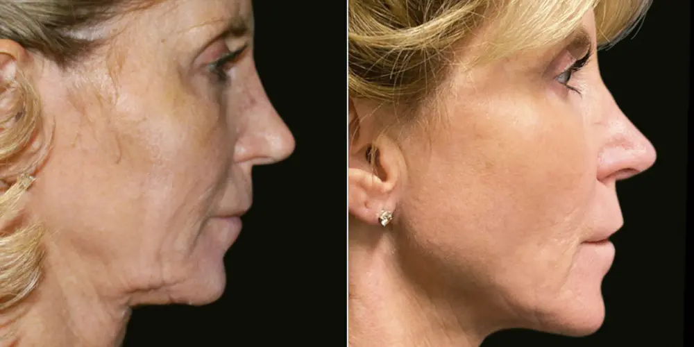 Renuvion Before-After 1