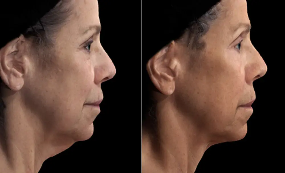 Renuvion Before and After 2